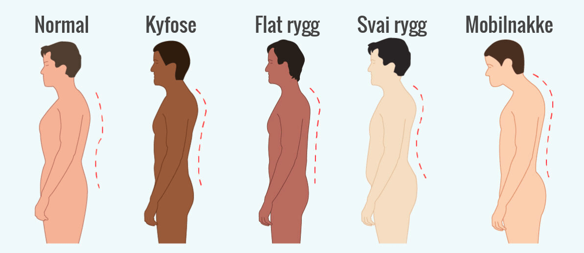 Ulike typer dårlig holdning